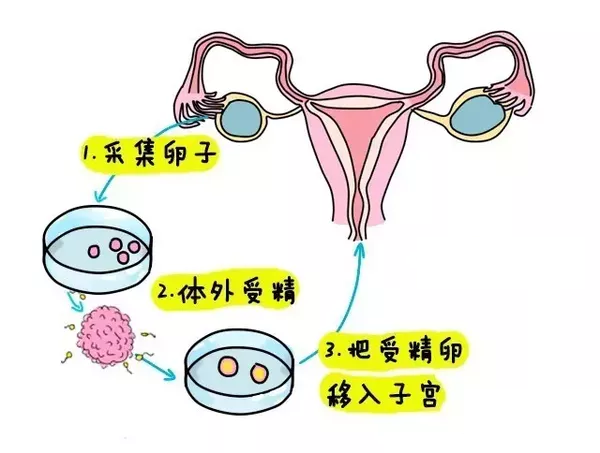 妊娠期糖尿病