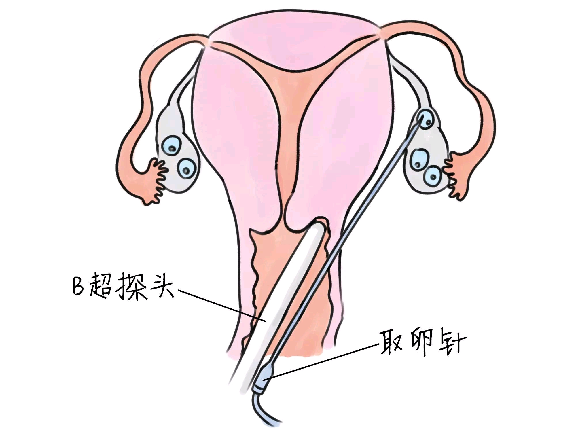 广州三代试管