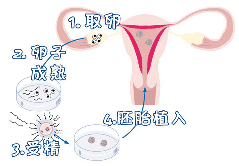 广州正规捐卵机构